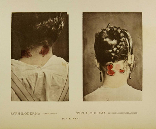 The back of a woman showing symptoms of syphilis on her neck.