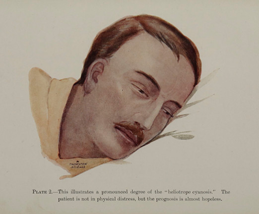 An illustration of a man sick with the flu. His skin is paling, he lies down on a pillow, and his eyes are struggling to open. It reads This illustrates a pronounced degree of the heliotrope cyanosis